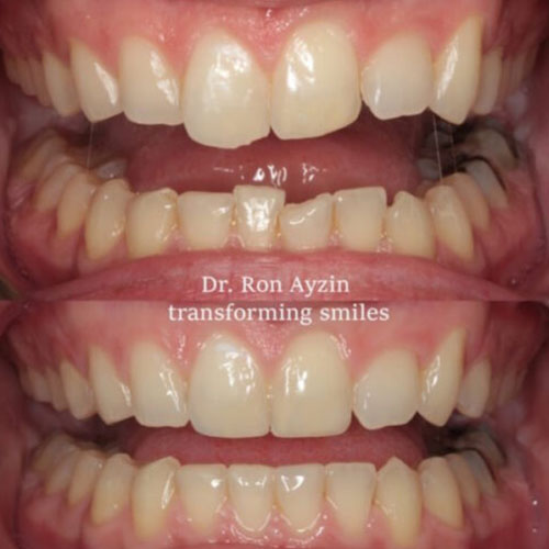Dental Veneers BA
