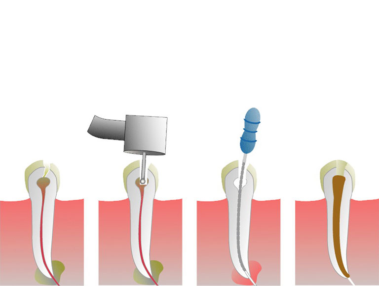 What is Endodontics