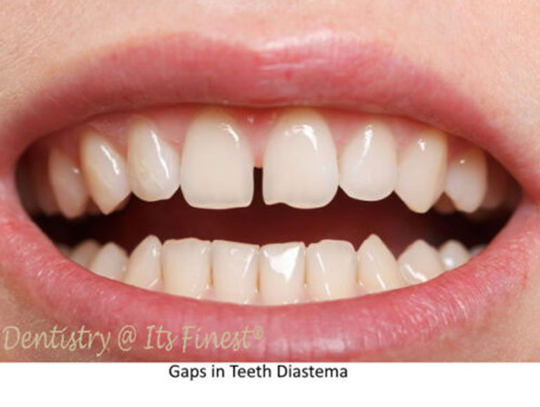 Gaps in Teeth Diastemas