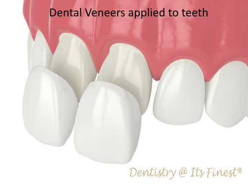 How veneers are applied