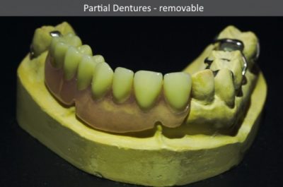 Partial Dentures- Removable