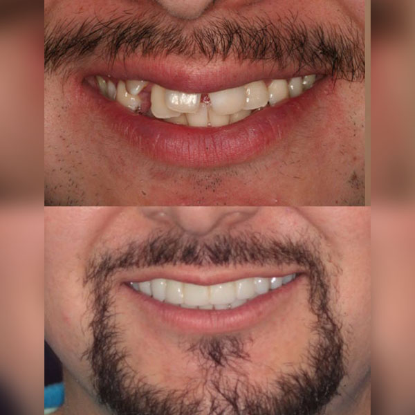 Implant Before and After