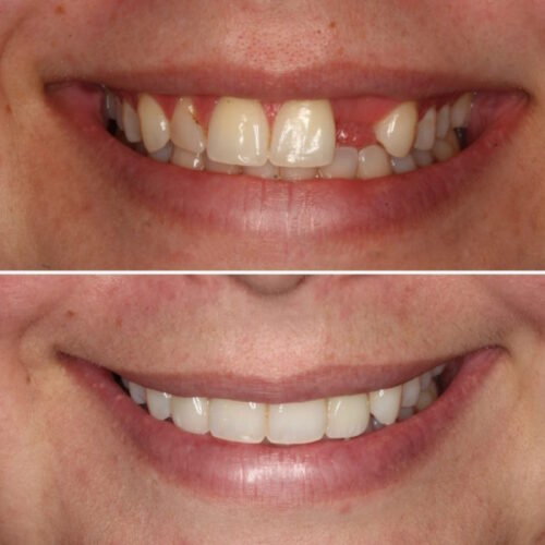 Implant veneers Invisalign BA