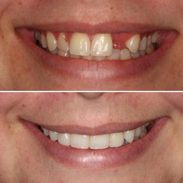 Implant Veneers Invisalign Bafore and After