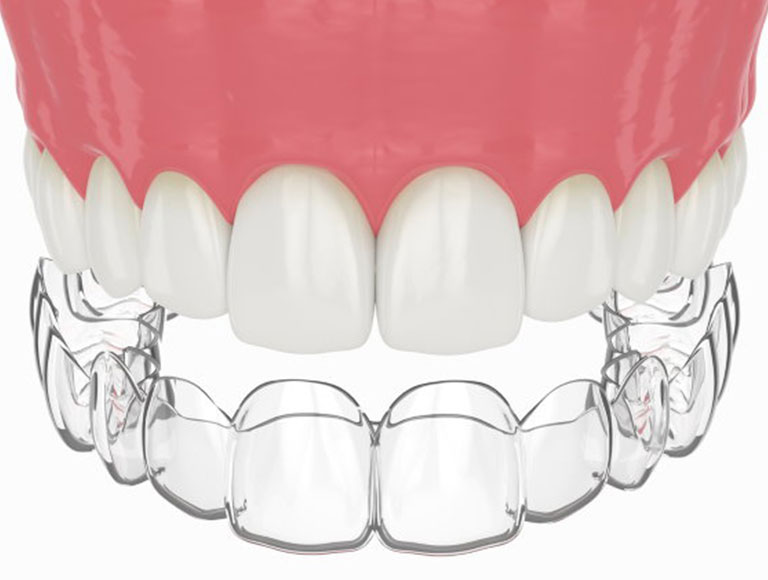 How much does Invisalign Cost?