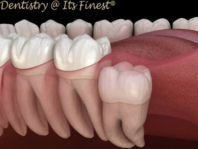Emergency wisdom teeth removal in Costa Mesa