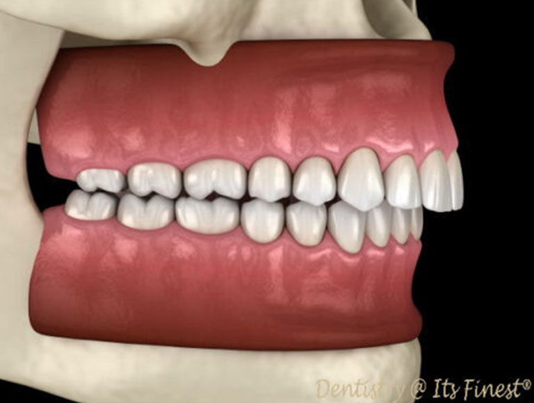 What is an Overbite?