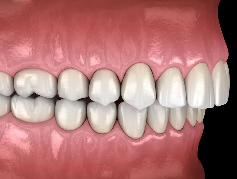 What issues does Overbites can cause?