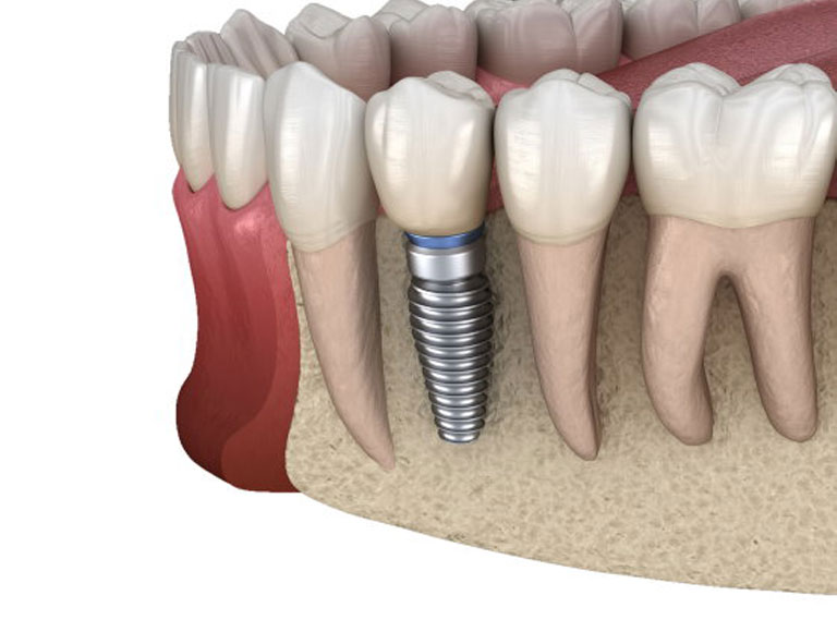 Dentistry At its Finest Tooth replacement for Irvine community