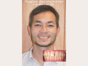 Phillip A: Fixed gaps in teeth