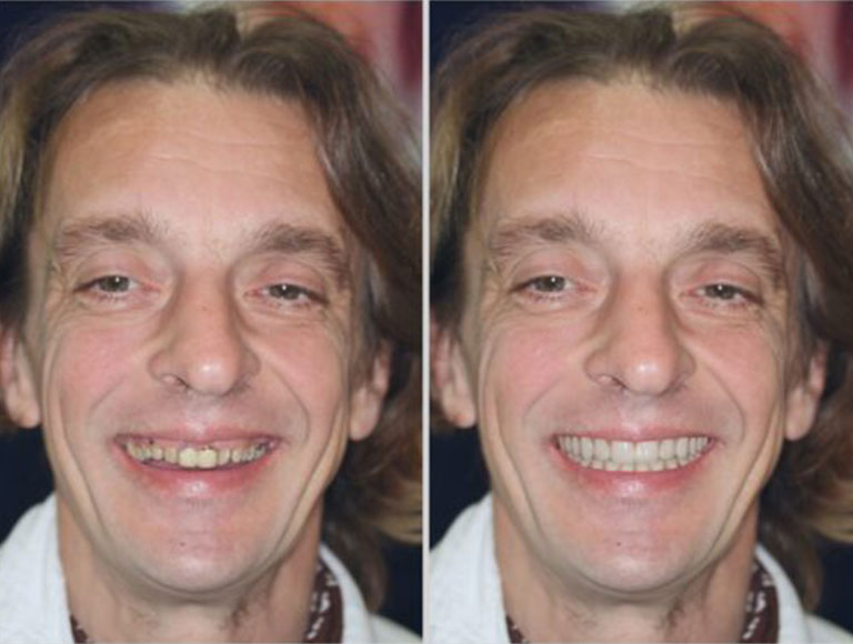 Preview of a Smile for an Actual patient before the work is done.
