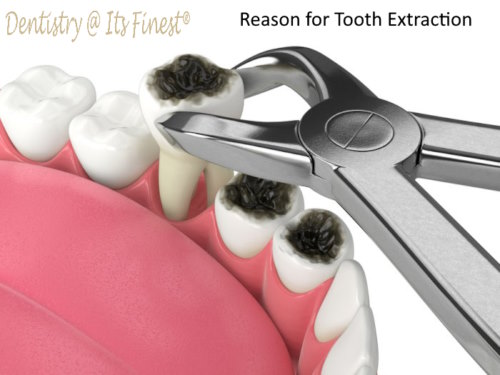 Reasons for tooth extraction