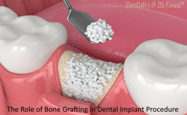 Role of bone grafting in dental implant procedure
