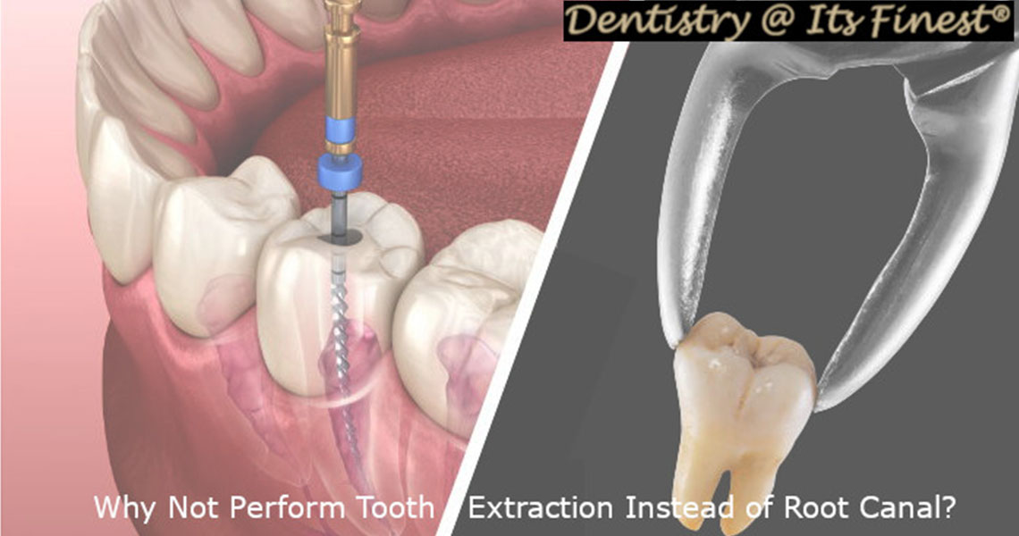 Tooth Instead of Performing a root canal