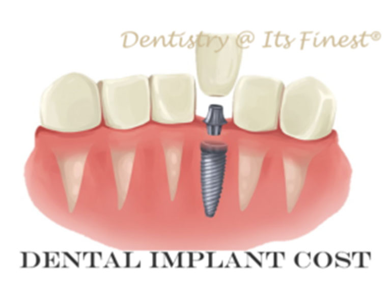 Dental Implants Cost Costa Mesa