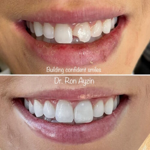 Single Veneers BA
