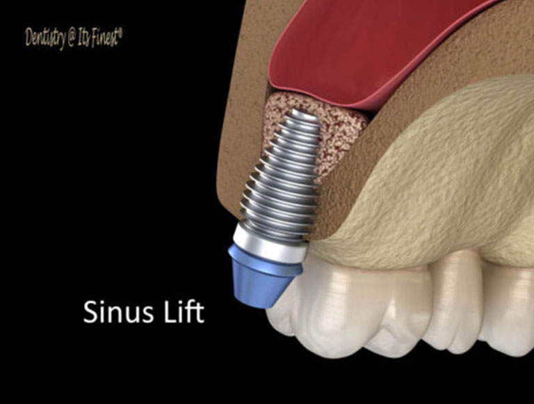 Sinus Lift