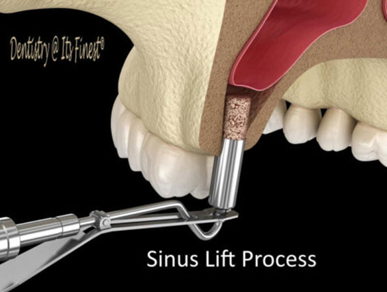 Sinus Augmentation