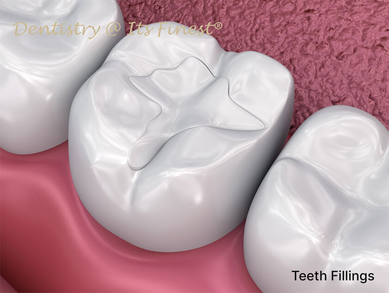 Dentistry At Its Finest Tooth Fillings for Costa Mesa Community