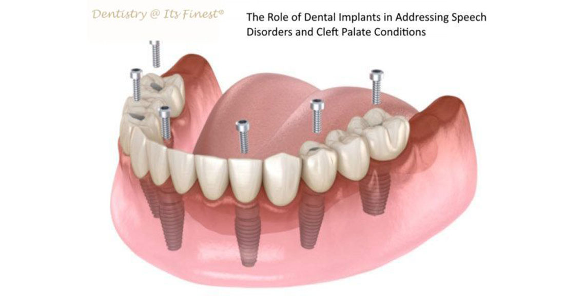 The Role of Dental Implants in Addressing Speech Disorders and Cleft Palate Conditions