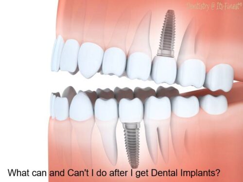 Things i can and cant do after dental implants