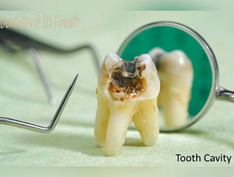 Tooth Cavity