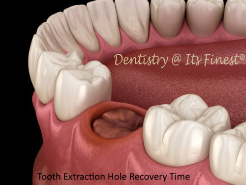 Tooth extraction hole healing time