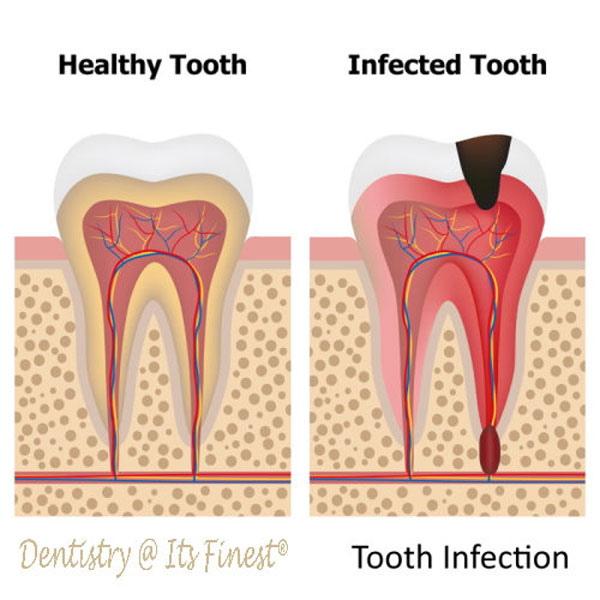 Infection Tooth