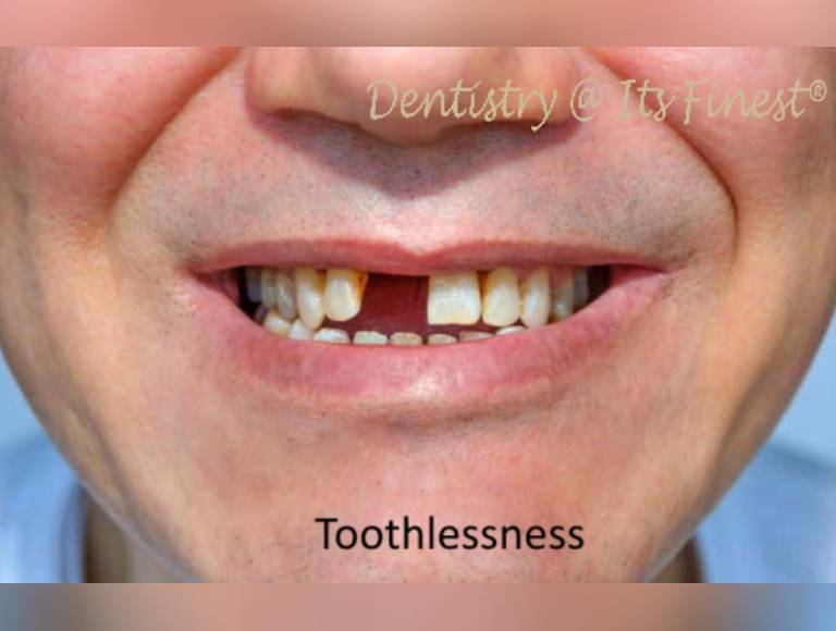 Edentulism - Front, Back Teeth, Age