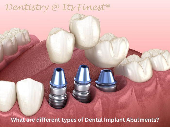 Types of dental implant abutments