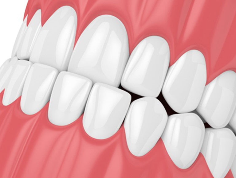 What Causes an Underbite?