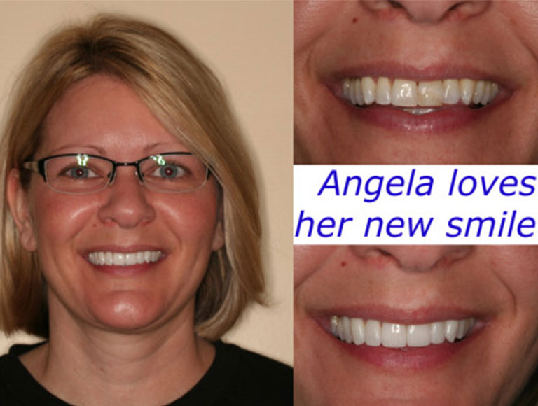 Best Veneers Dentist