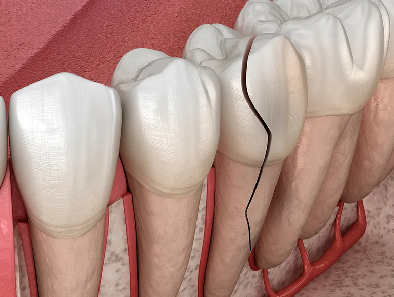 What Can Cause a Tooth To Crack?