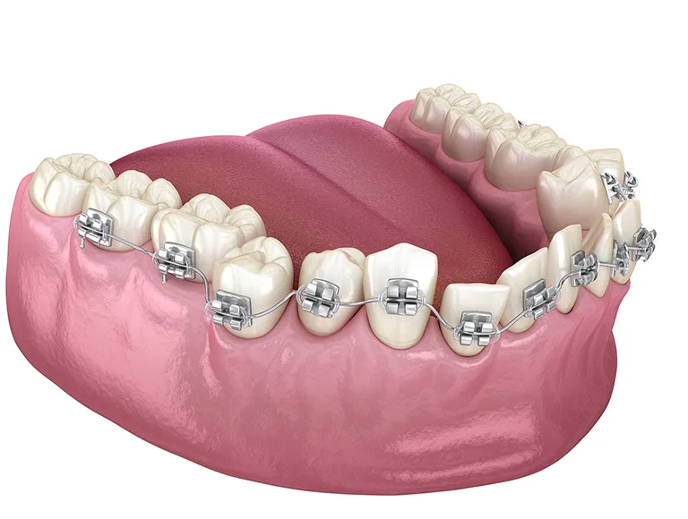 Ceramic bracket braces for Adults