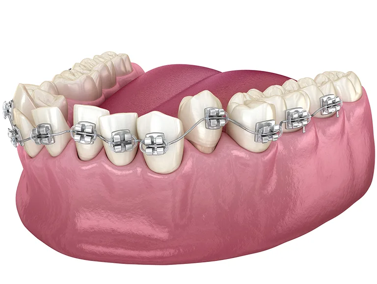 Ceramic bracket braces for Adults