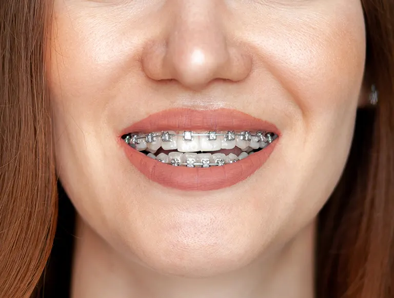 Ceramic bracket braces for Adults