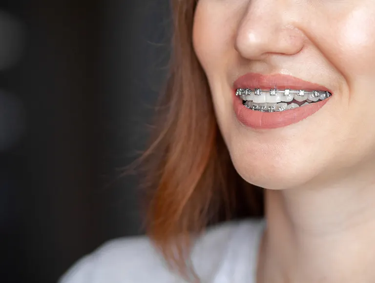 Ceramic bracket braces for Adults