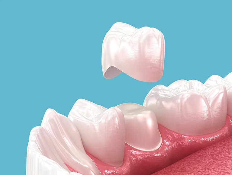 Dental Crown Cost