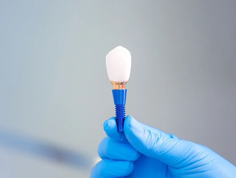 Dental Implant worth