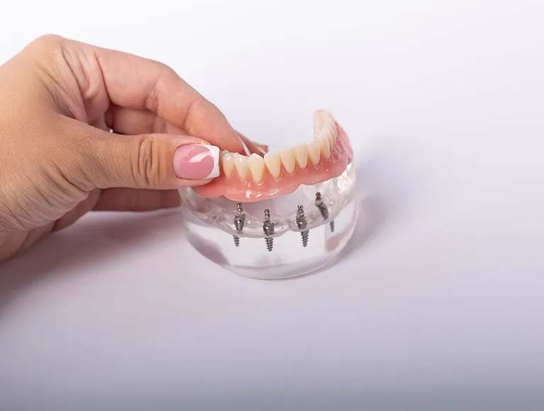Dental implants Periodontist
