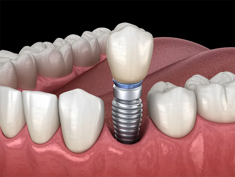 Dental implants Periodontist