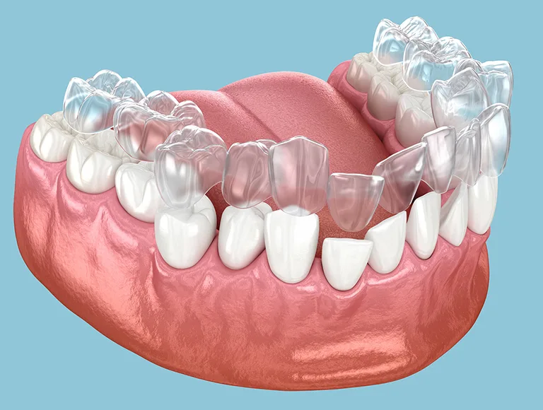 How Long Does Invisalign Take