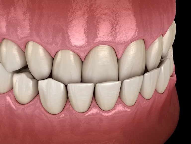 Overbite Vs Underbite