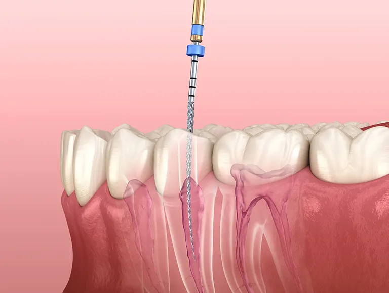 Root canal cost
