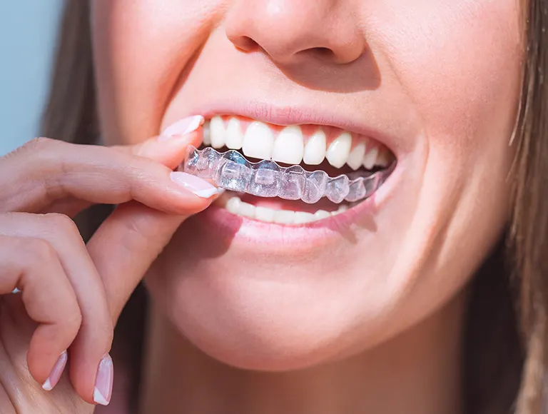 Teens Invisalign® Santa Ana: Affordable