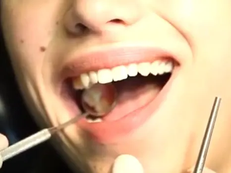 Tooth Extraction Treatment