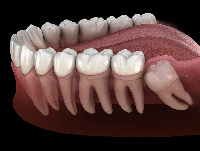 Wisdom Teeth Removal Cost Near