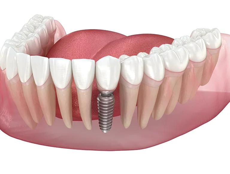 How much for a dental implant