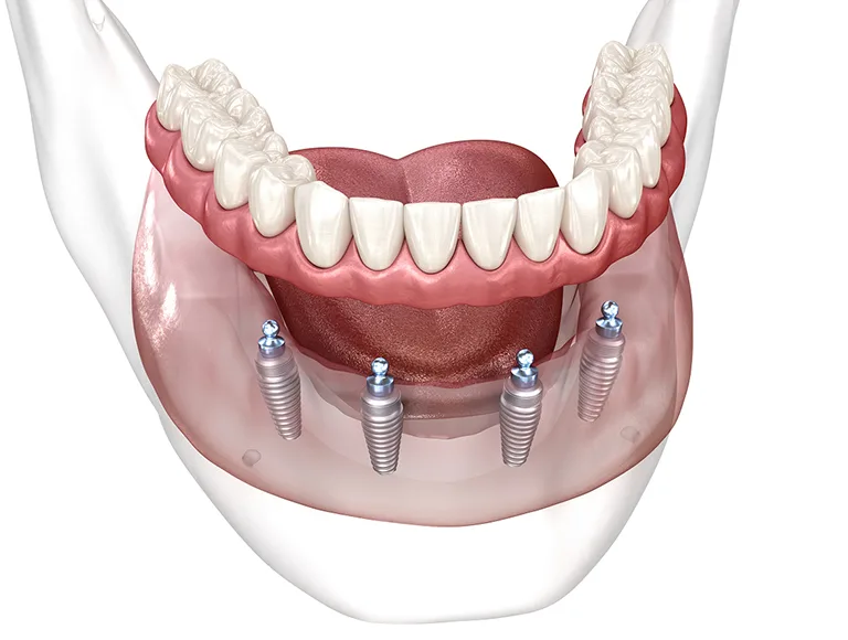 Fixed Implant Dentures