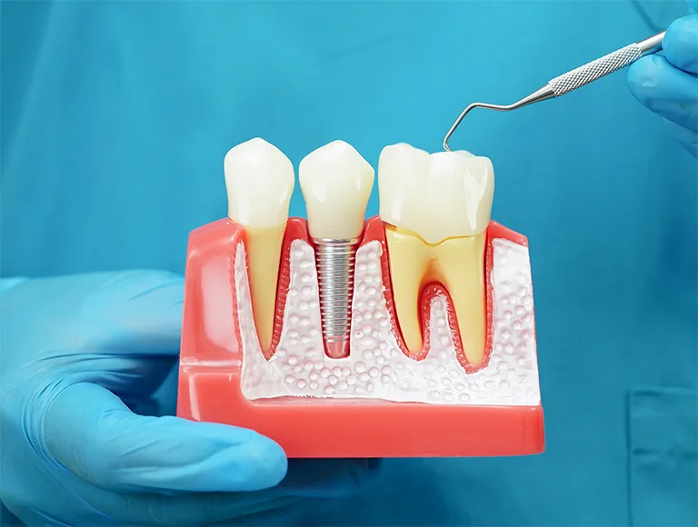 Fixed Implant Dentures